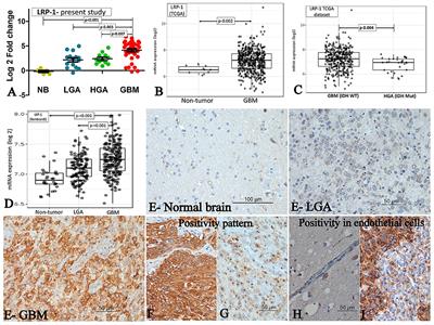 Elevated expression of cholesterol transporter LRP-1 is crucially implicated in the pathobiology of glioblastoma